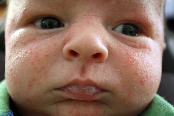 tre so sinh - Trẻ sơ sinh dễ mắc những bệnh ngoài da nào?